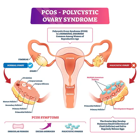 Steroid Panel For PCOS/CAH Differentiation